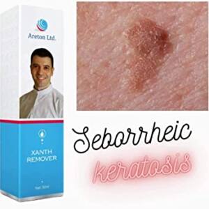 Mejor crema para queratosis seborreica